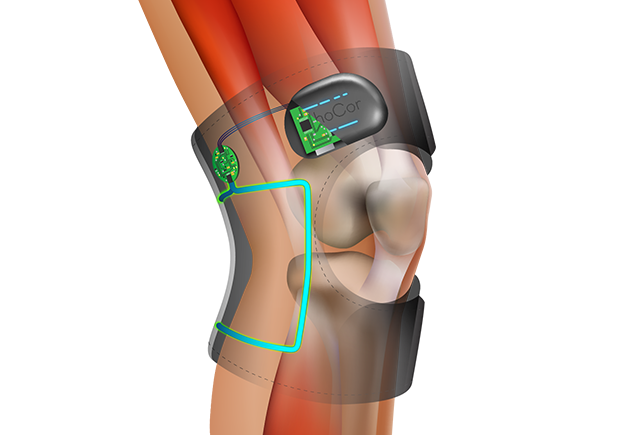 Illustration of the antenna loop on the OrthoCor Knee device highlighting the source of PEMF therapy.